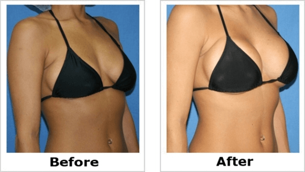 Shayanne before and after breast image